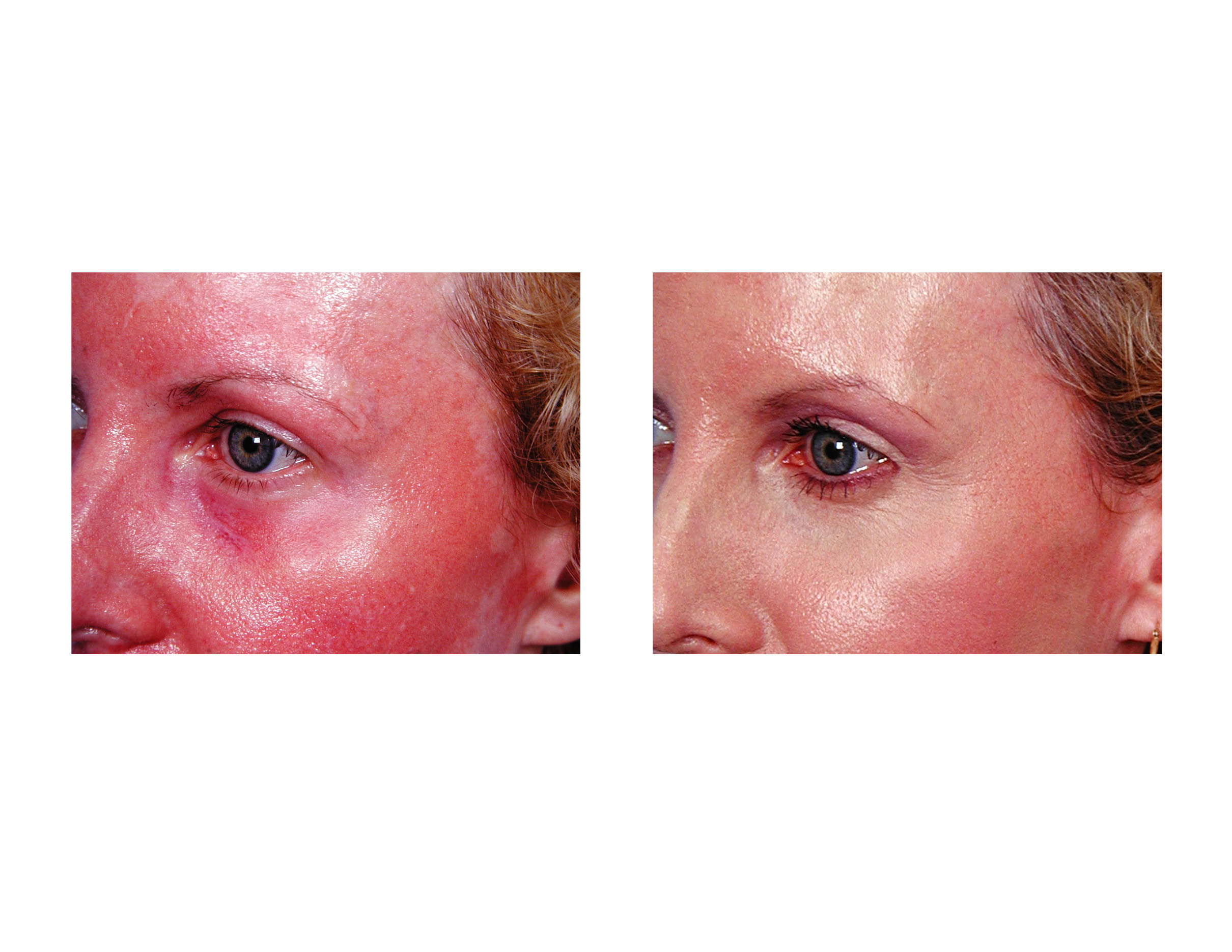 Facial Laser Resurfacing Archives