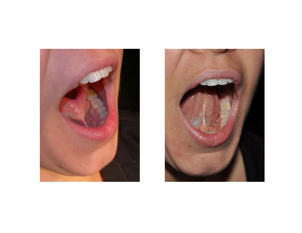 Adult Tongue 104