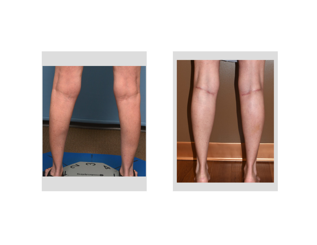 Female Calf Augmentation Result Back View Dr Barry Eppley Indianapolis