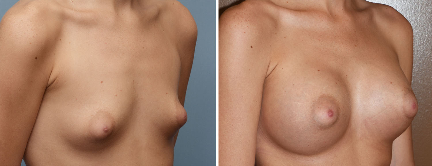 Breast Nipples Puffy 112