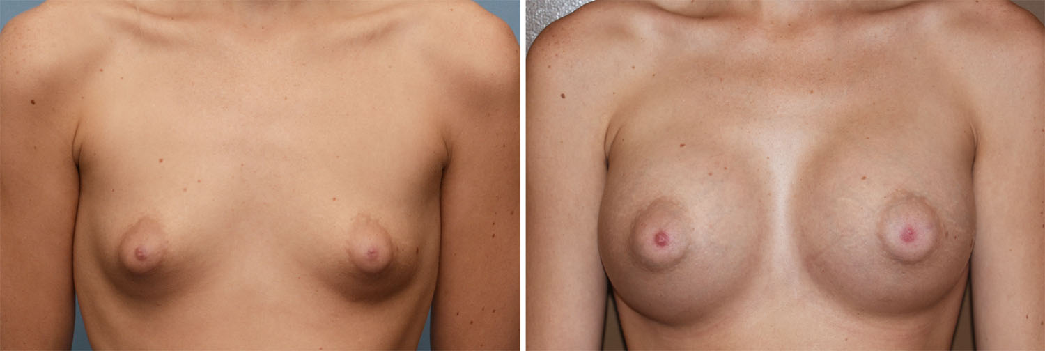 Puffy Breast Nipples 112
