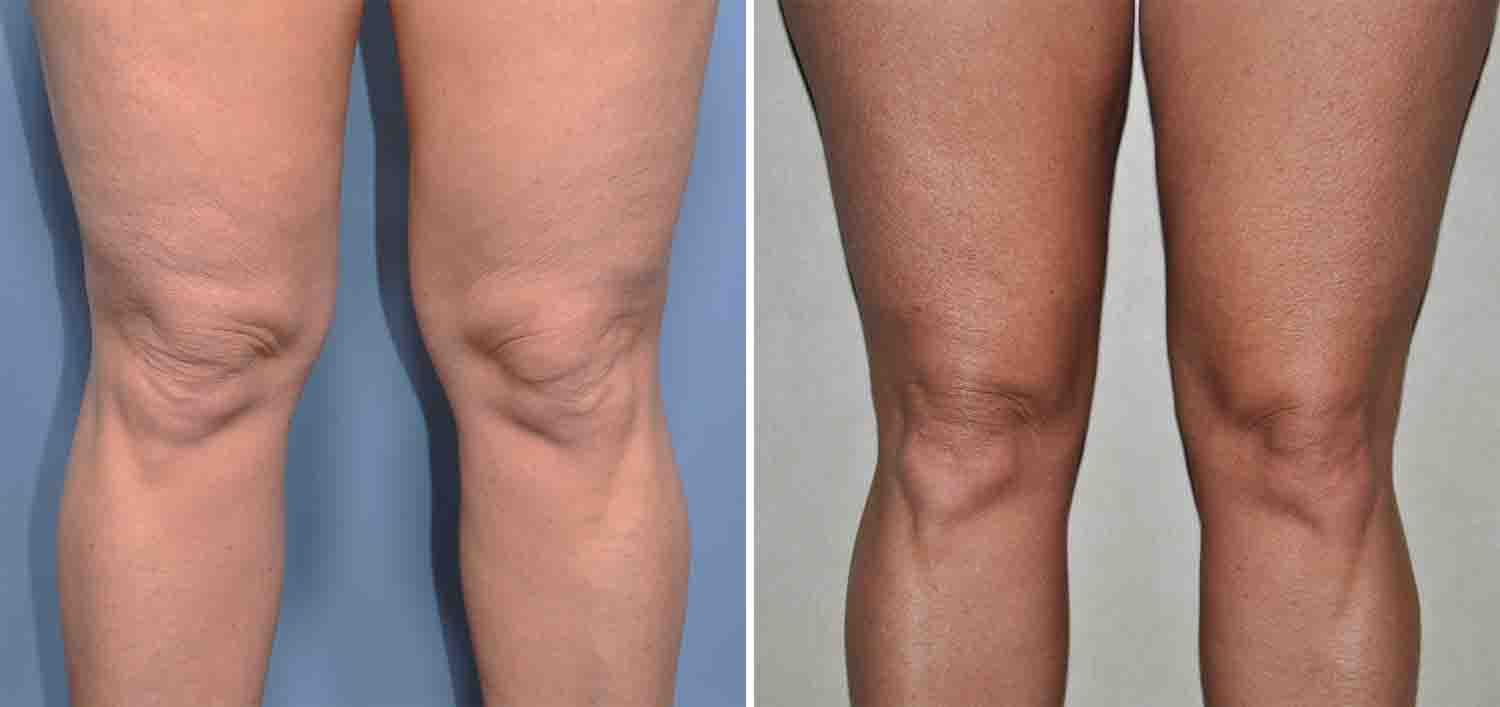 Knee Fat Removal 66