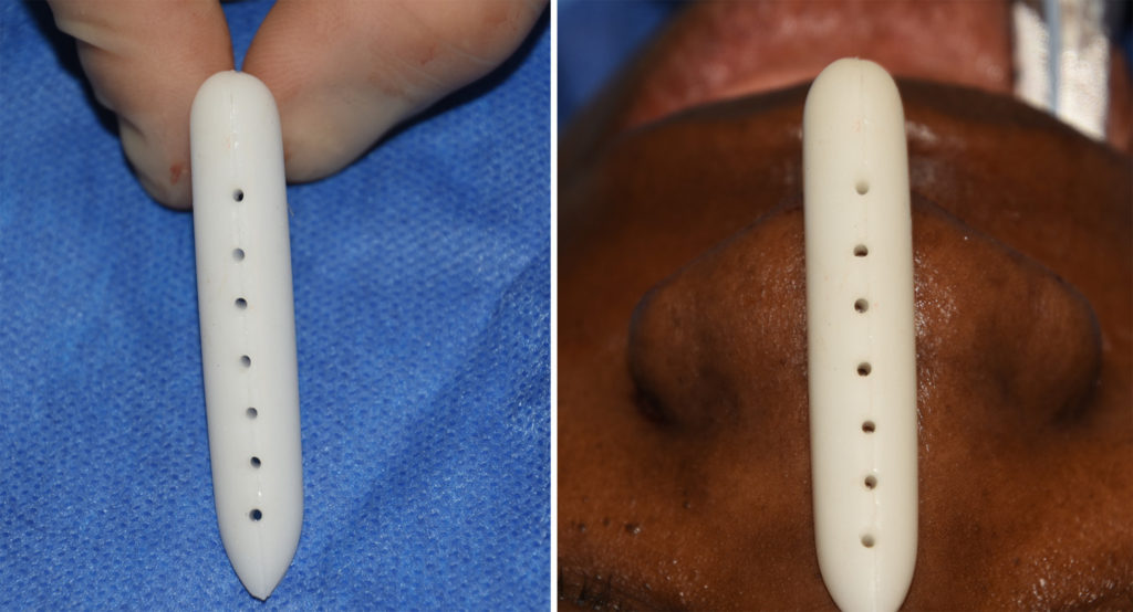 Technical Strategies Tissue Ingrowth Into Solid Silicone Nasal