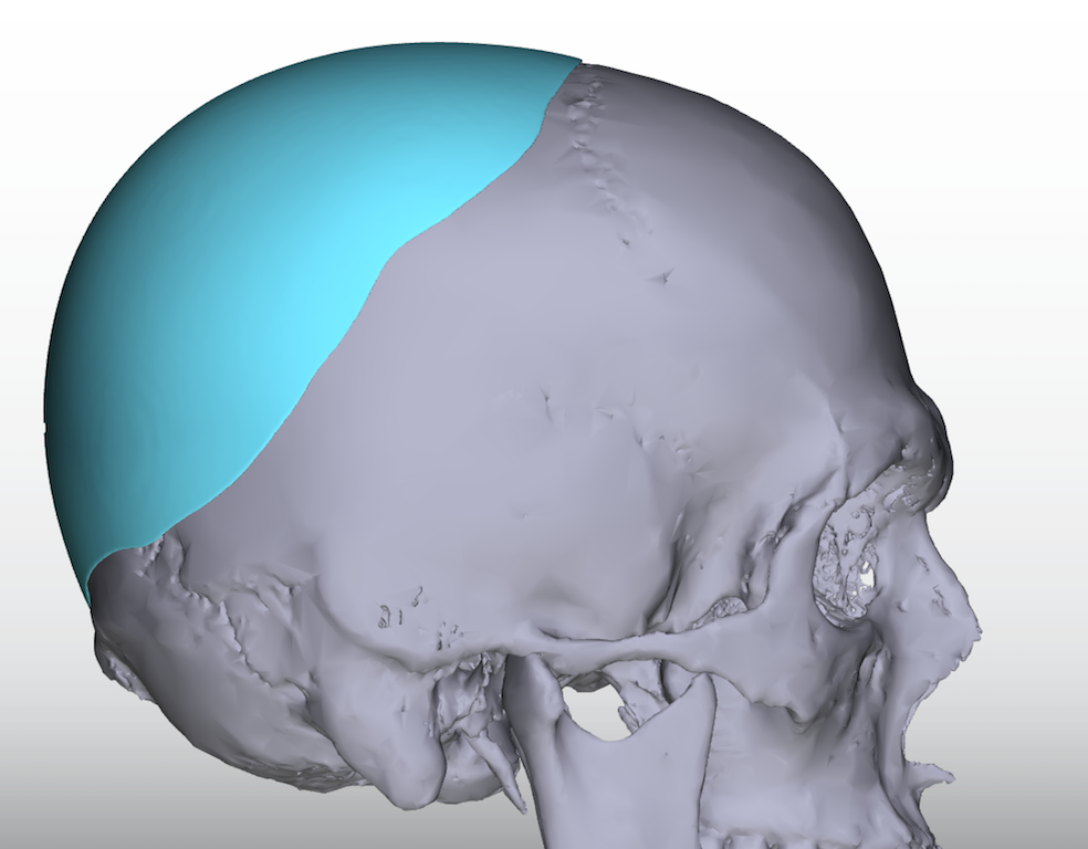 Custom Skull Implant Design For A Flat Back Of The Head Side View Dr