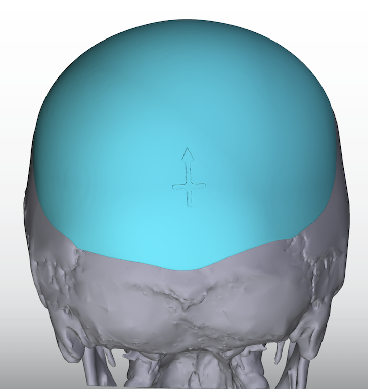 Custom Skull Implant For Flat Back Of The Head Back View Dr Barry