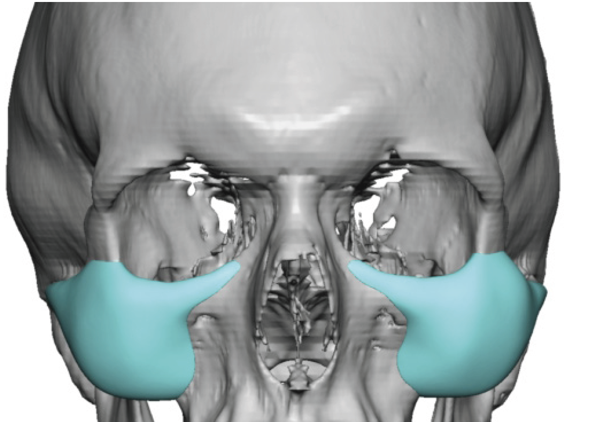 Custom Infraorbitsl Malar Implants Design Front View Dr Barry Eppley