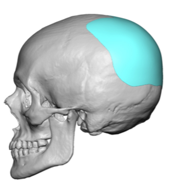 Custom Skull Implant For Flat Back Of Head Design Dr Barry Eppley