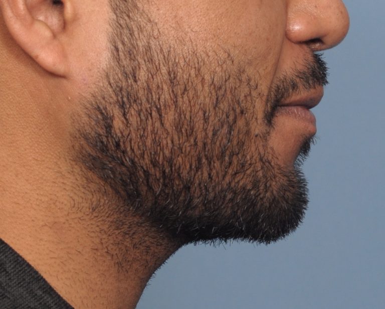 Plastic Surgery Case Study Custom Jawline Implant Results In The Male