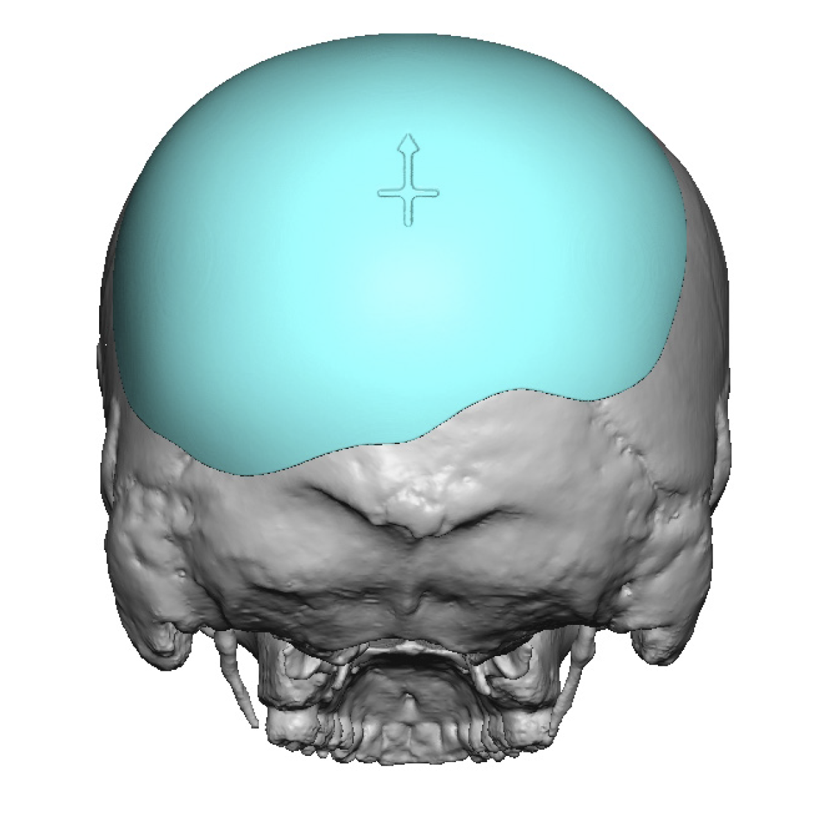 Custom Back Of The Head Skull Implant Design Back View Dr Barry Eppley