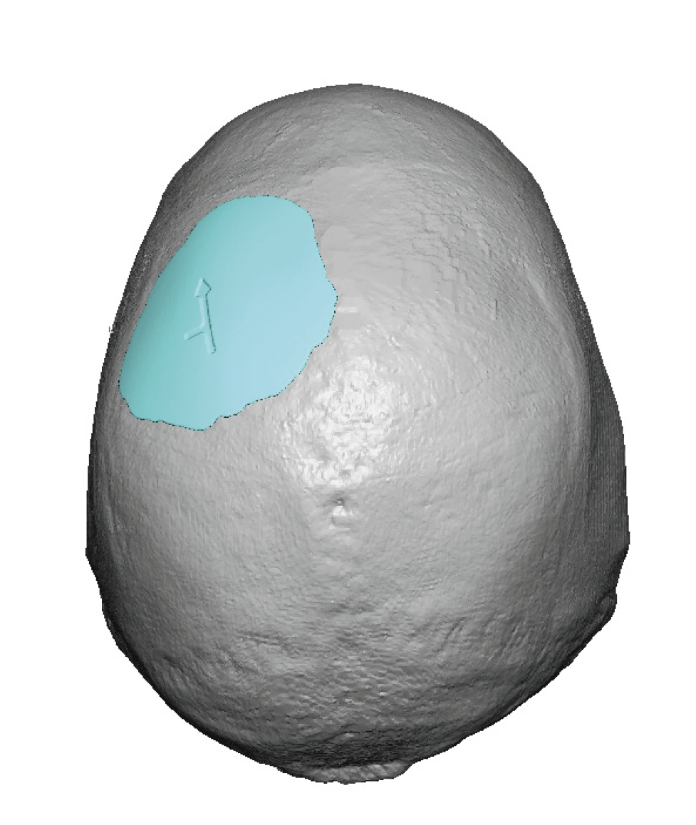 Plastic Surgery Case Study Small Custom Skull Implant For Circular