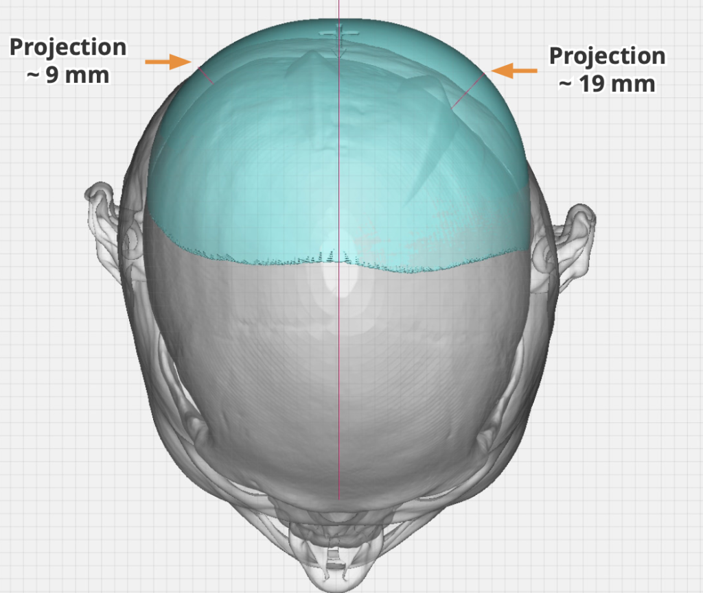 Plastic Surgery Case Study The Unintentional Two Stage Back Of Head