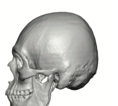 Male Custom Back Of Head Skull Implant Design Side Before Dr Barry