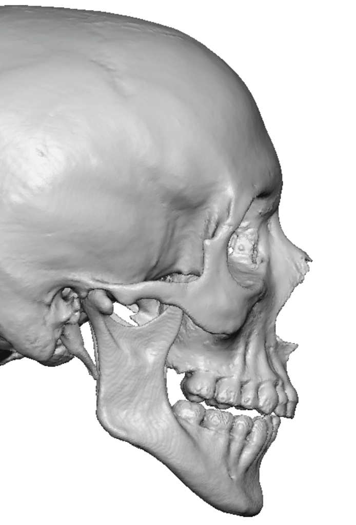 Plastic Surgery Case Study Masculinizing The Upper Face With A Custom