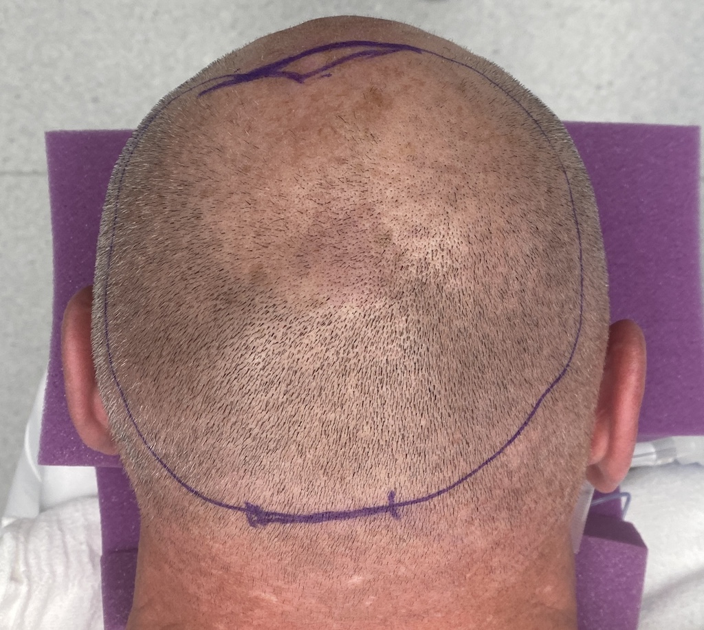 Plastic Surgery Case Study Male Back Of The Head Contouring With A