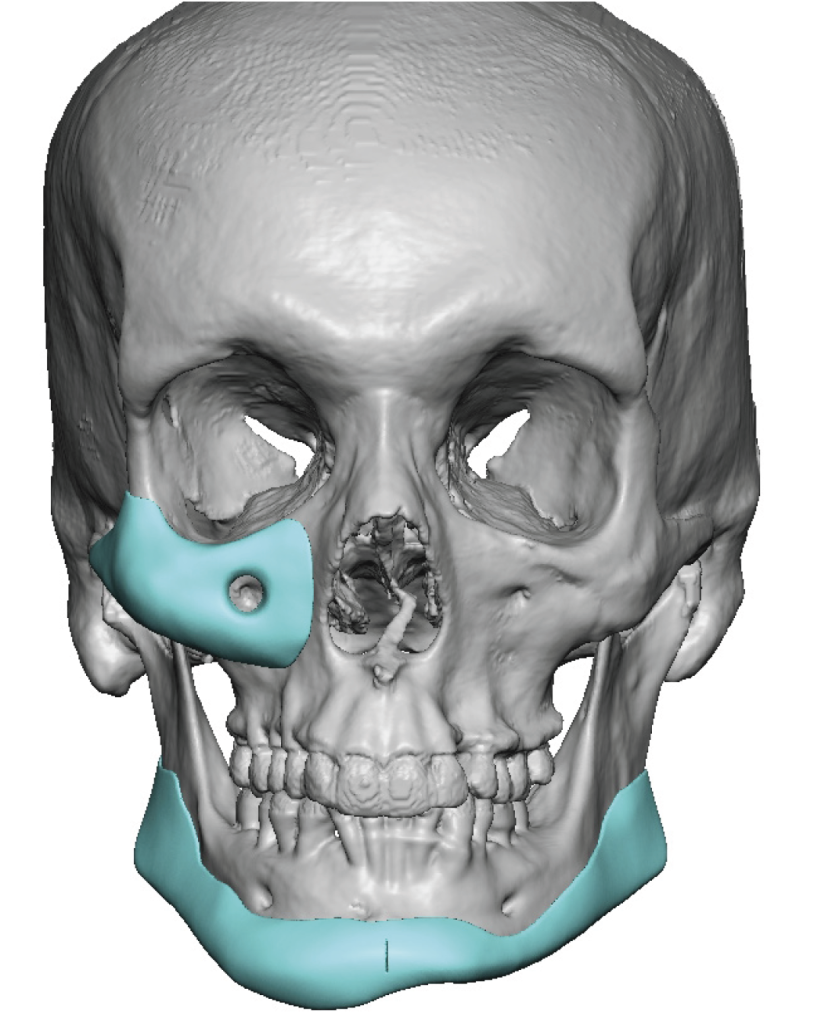 Plastic Surgery Case Study Custom Midface And Jawline Implants In