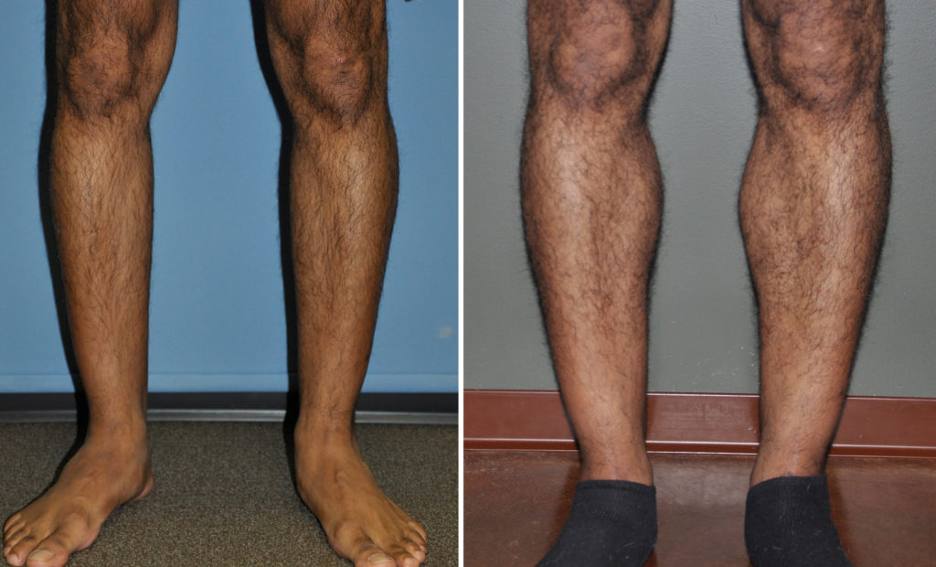 Calf Implants for Lower Leg Enhancement Explore Plastic Surgery