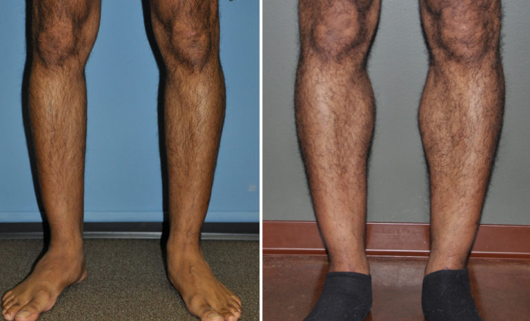 Calf Implants for Lower Leg Enhancement - Explore Plastic Surgery