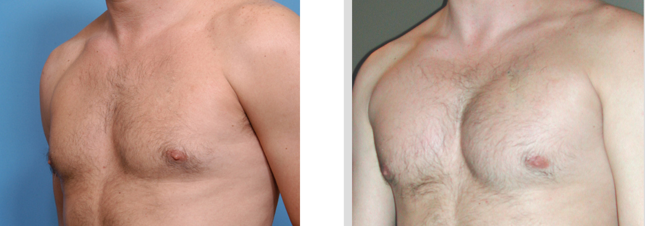 Male Chest Enlargement, Pectoral Shaping for Men