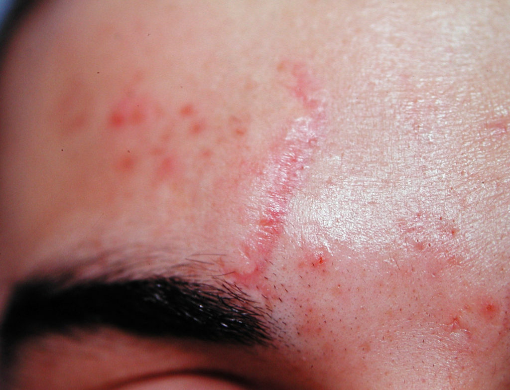 scar-redness-explore-plastic-surgery