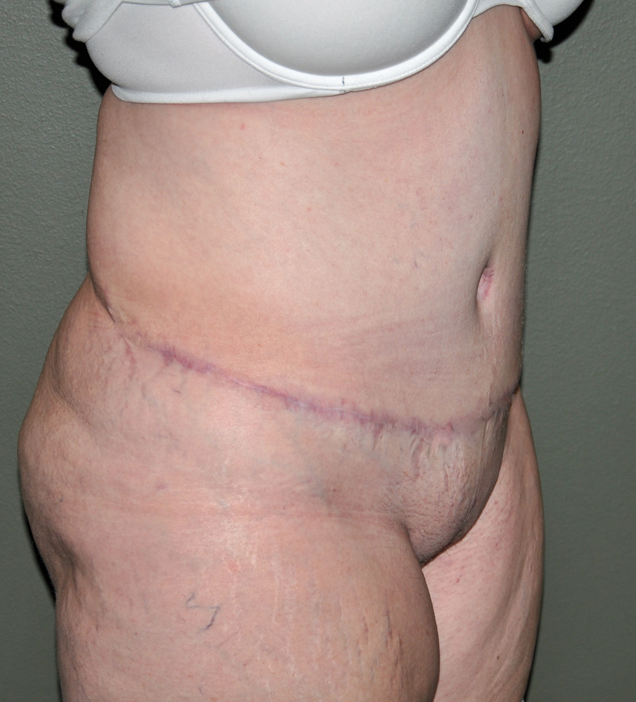 Tummy Tuck Options in the Extreme Weight Loss Patient - Explore Plastic  Surgery