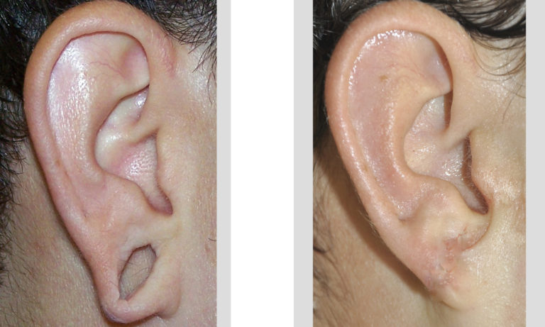 The Energing Trend Of Stretched Gauged Earlobe Repair Explore Plastic Surgery 9437
