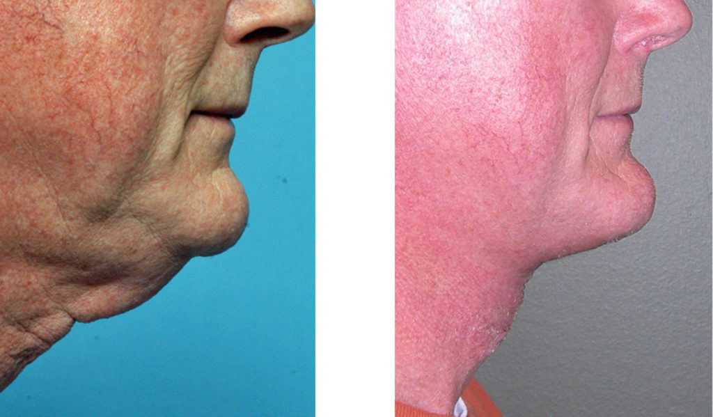 Direct Neck Lift in Men - Explore Plastic Surgery