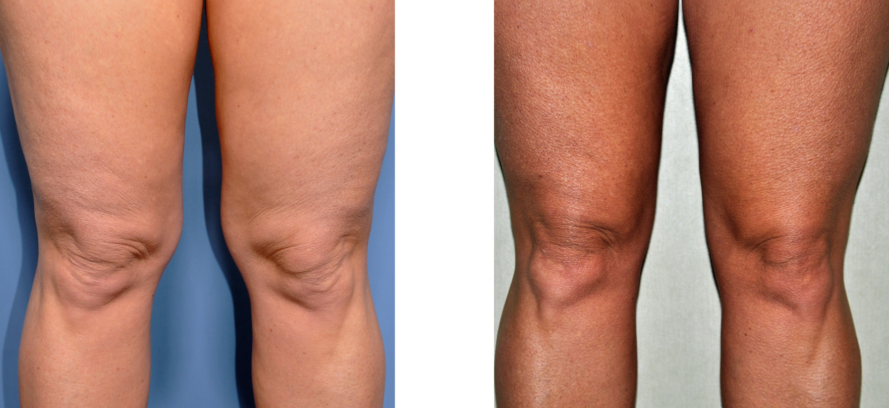 Liposuction of the Knees - Helping to Reshape the Legs - Explore