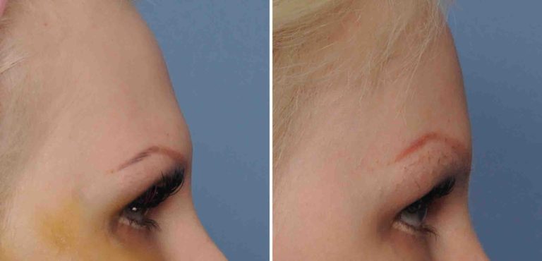 Options For Brow Bone Reduction In Men And Women - Explore Plastic Surgery