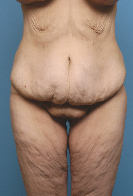 Body Contouring After Major Weight Loss: The Patient's Journey
