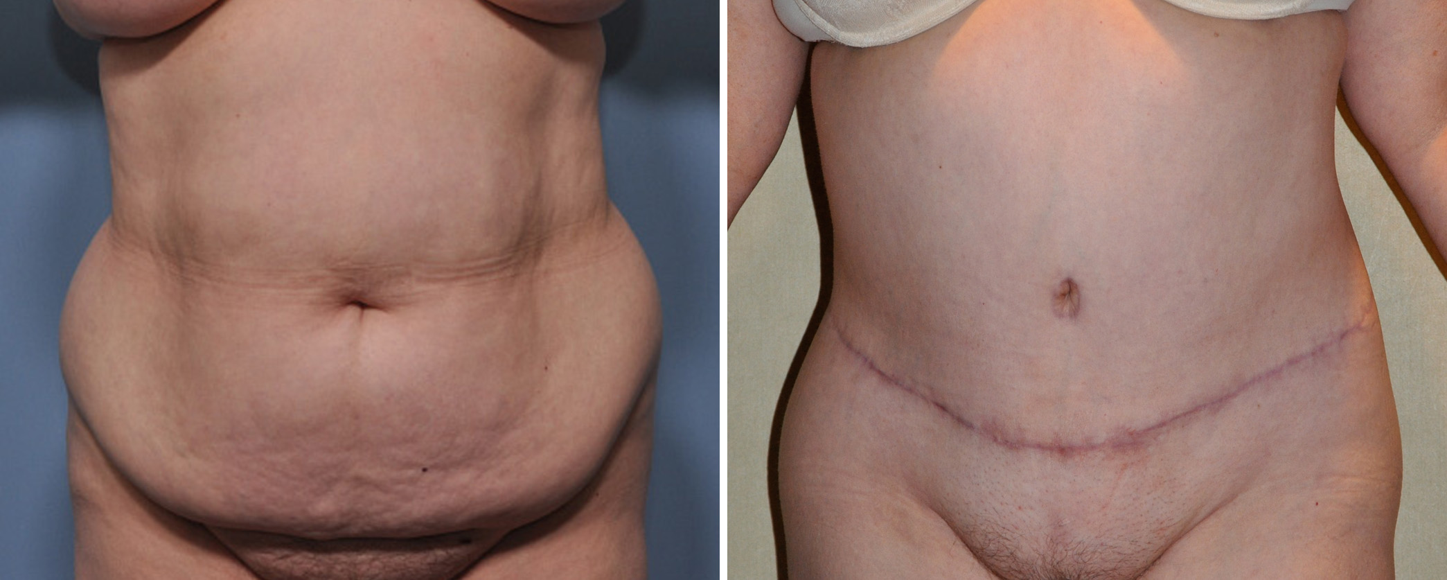 Understanding the Abdominal Panniculectomy - Explore Plastic Surgery