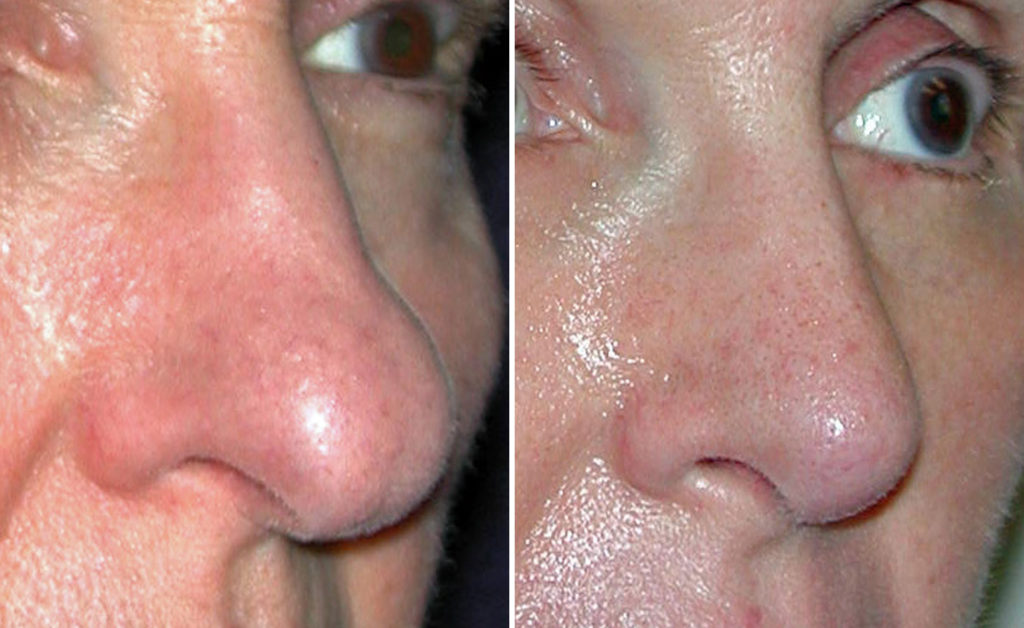 Rhinoplasty For The Aging Nose Explore Plastic Surgery