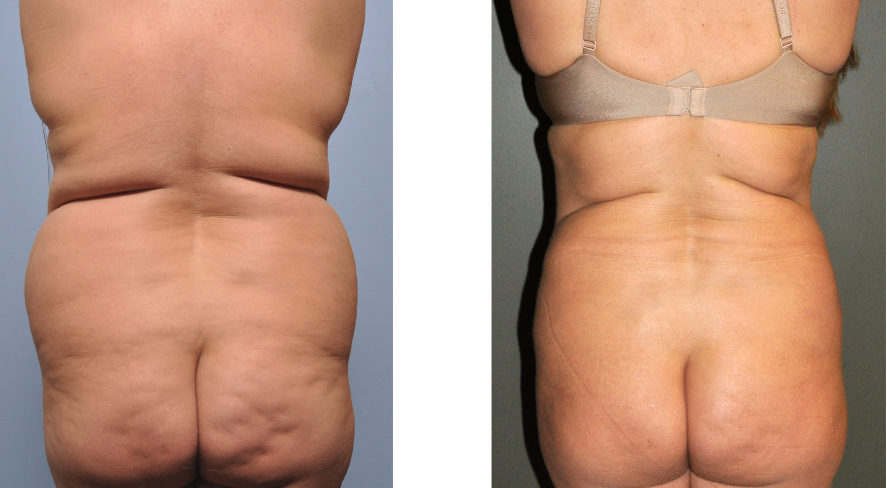 The big question: Are liposuction results immediate?