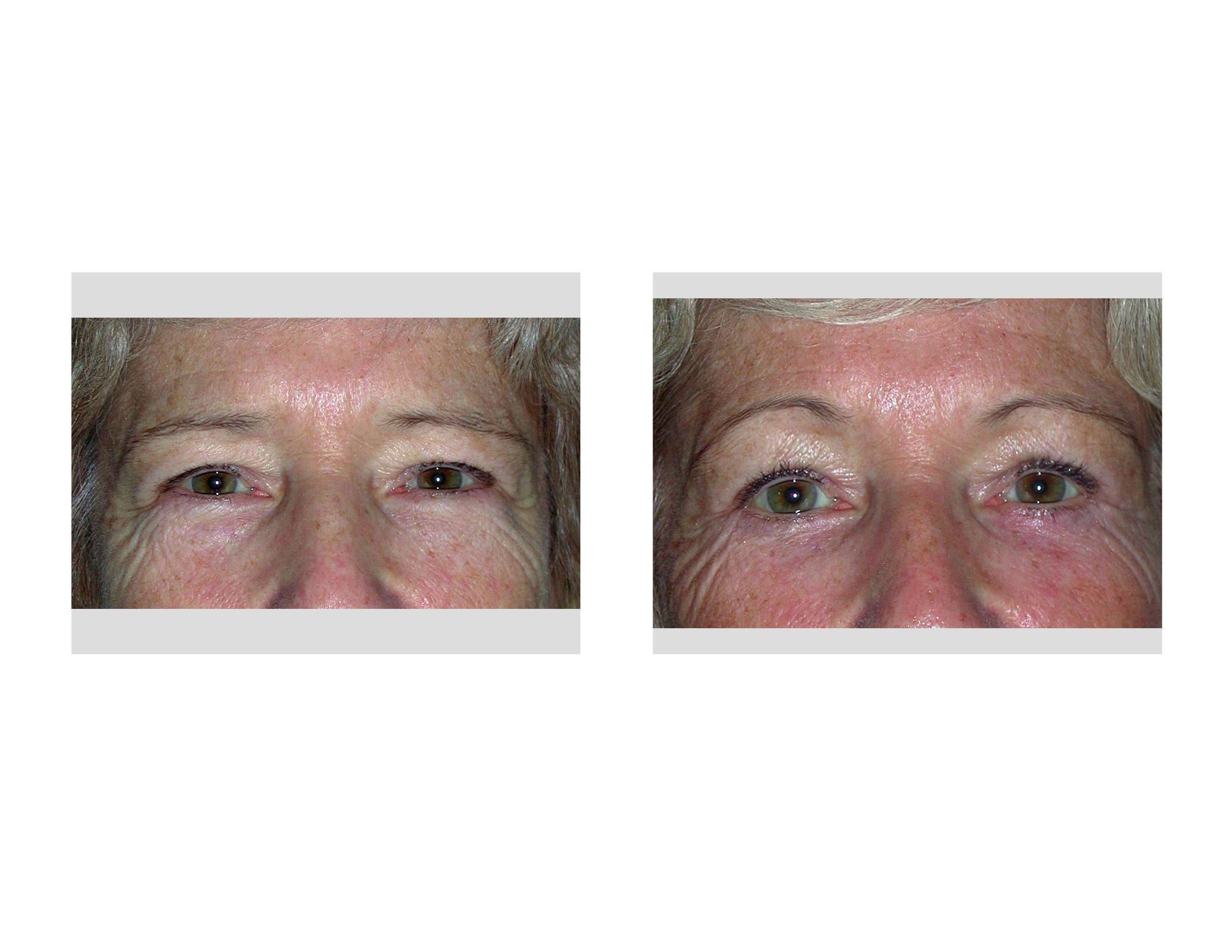 browliftplasticsurgeryindianapolisdrbarryeppley Explore Plastic