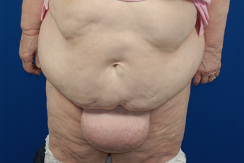 Pubic Lifts Monsplasty In Extreme Weight Loss Women Explore Plastic Surgery