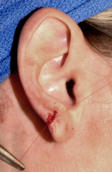 Cosmetic Ear Surgery Edinburgh, Split Earlobe