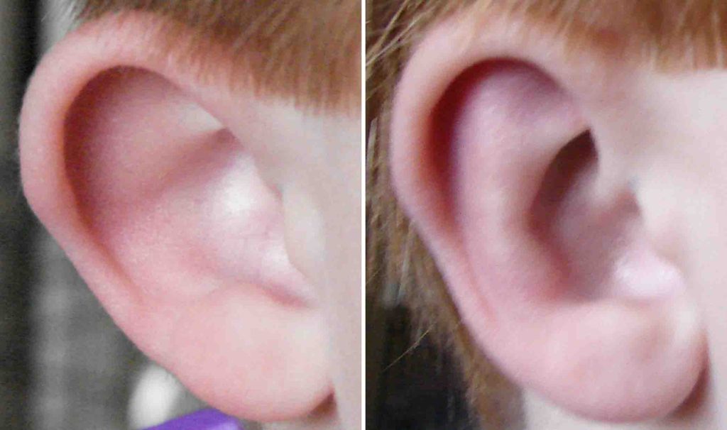 Otoplasty Identifying and Reshaping Malformed Ear Cartilages