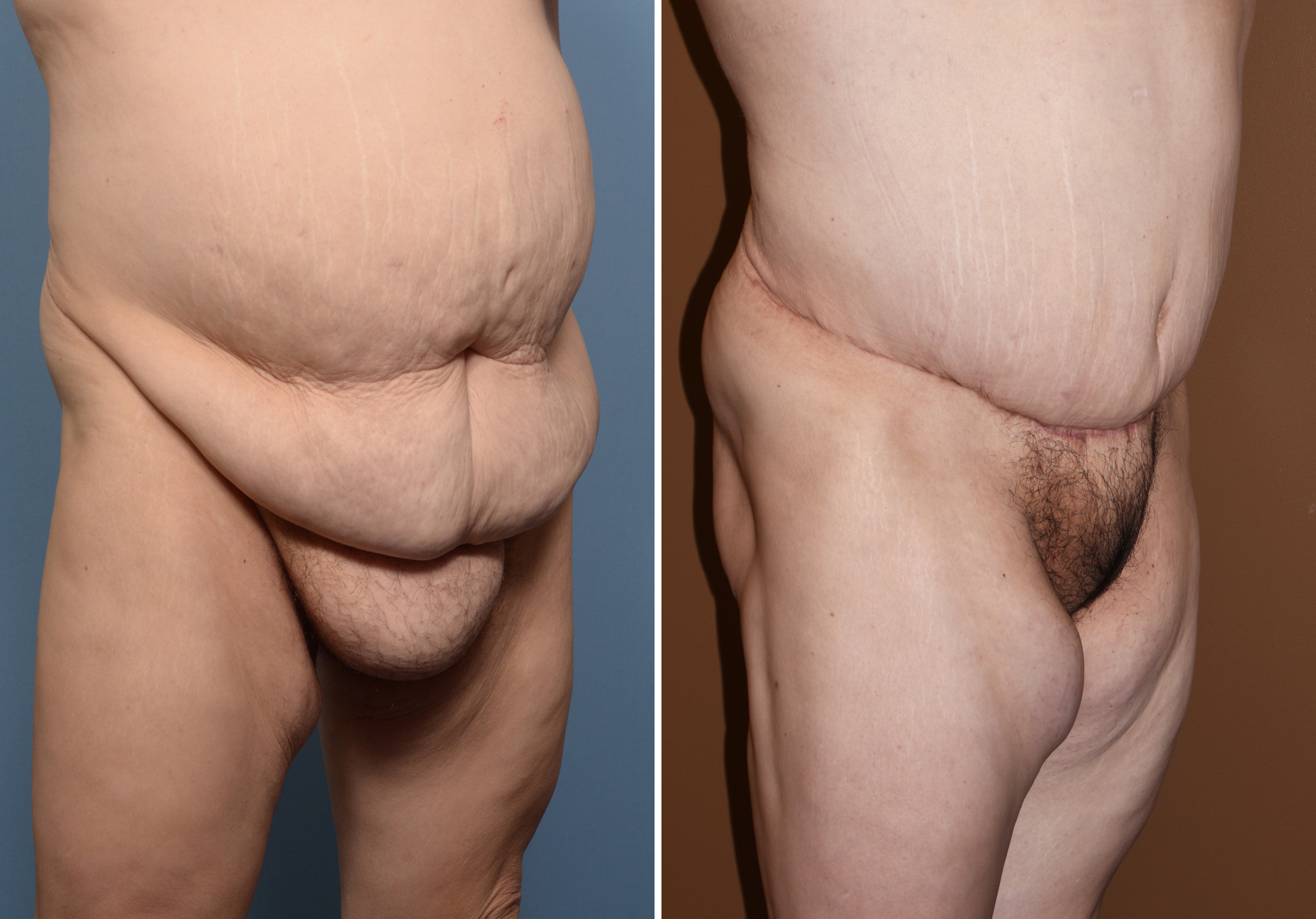 Pubic Lifts and Liposuction for Mons Rejuvenation - Explore Plastic Surgery
