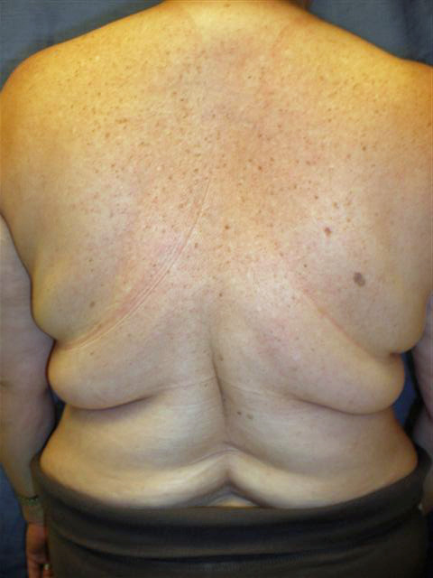 Smartlipo of the Back - Flanks, Bra Rolls, and Neck Humps - Explore Plastic  Surgery