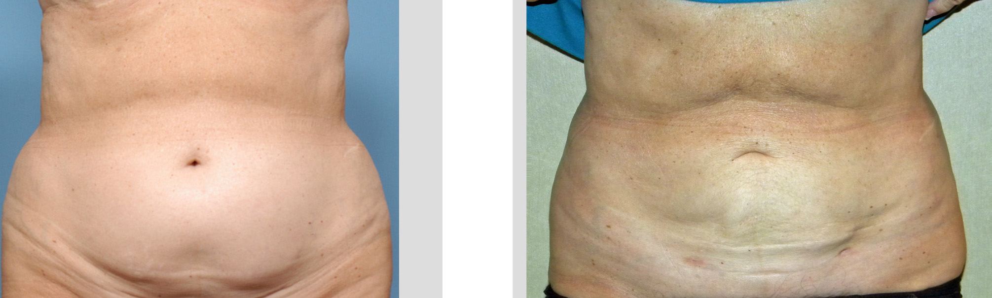 Abdominal Liposuction - Jelly Belly vs Watermelon Bellies - Explore Plastic  Surgery