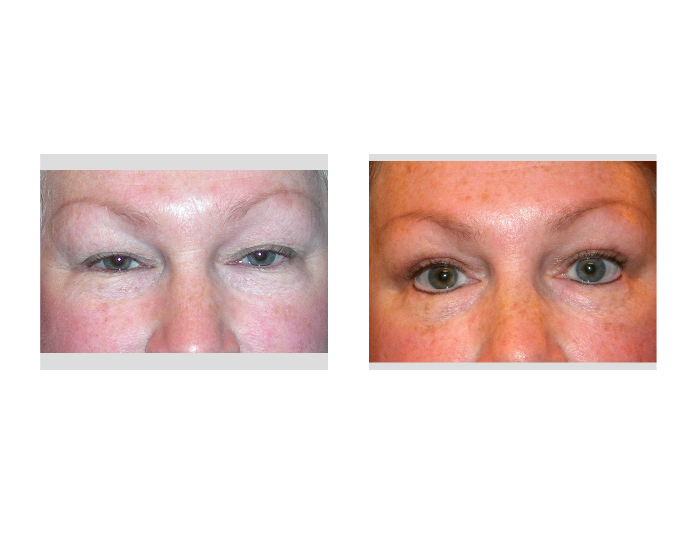 indianapolisblepharoplastydrbarryeppleyindianapolis Explore