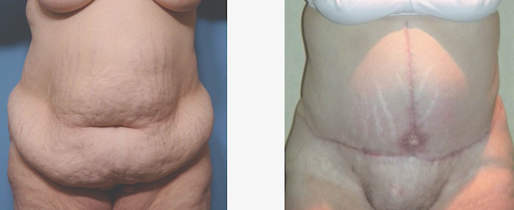 Reverse Tummy Tuck and Circumferential Abdominal Skin Excision 8 Before &  After Photos Lansing, MI - Michigan Plastic Surgery