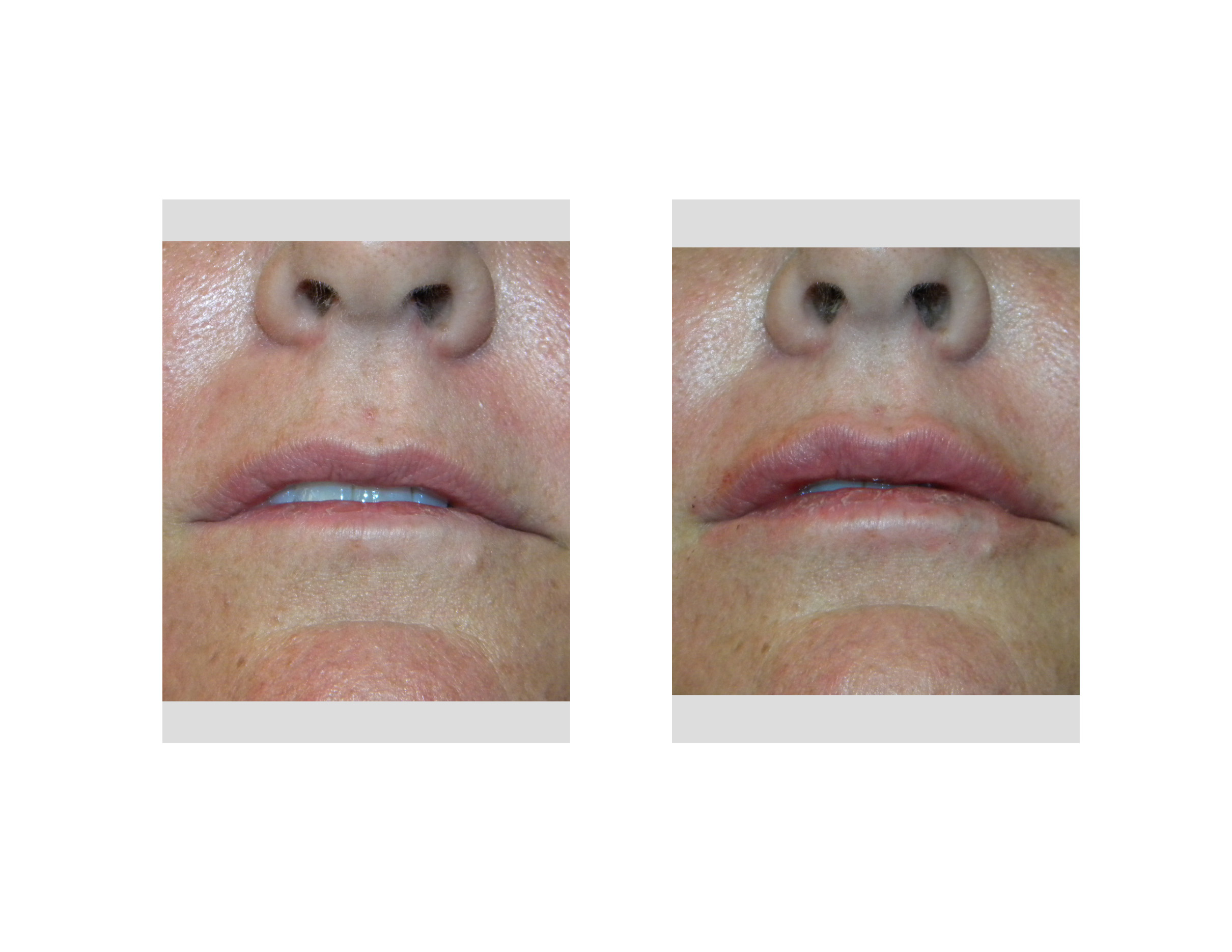 Lip augmentation with hyaluronic acid. Reviews of beauticians. How to increase lips 93 Lip augmentation with hyaluronic acid. Reviews of beauticians. How to increase lips 98
