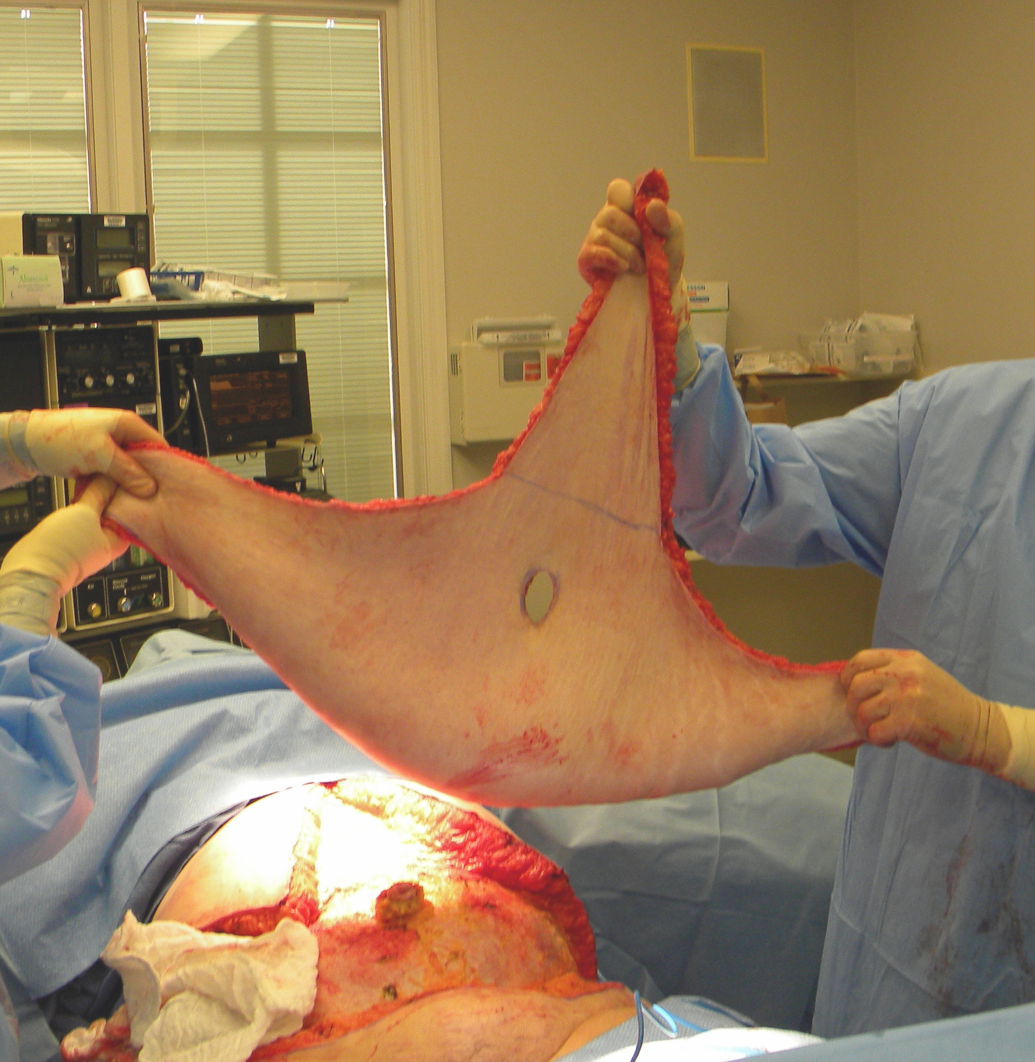 https://exploreplasticsurgery.com/wp-content/uploads/2009/09/abdominal-pannus-removal-dr-barry-eppley-indianapolis.jpg