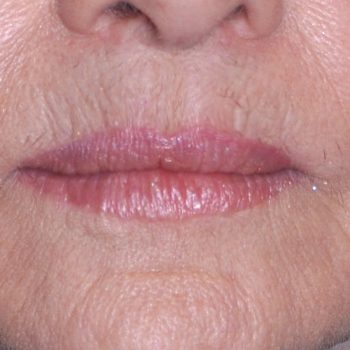 Lip and Corner Tuckups for the Aging Mouth - Explore Plastic Surgery