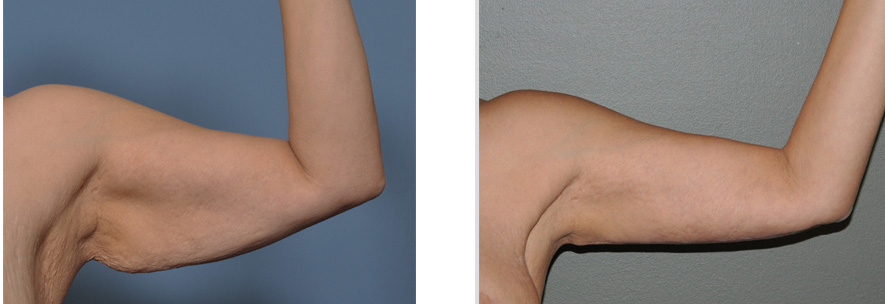 Arm Lift for Fort Worth & Plano - 2301 Plastic Surgery