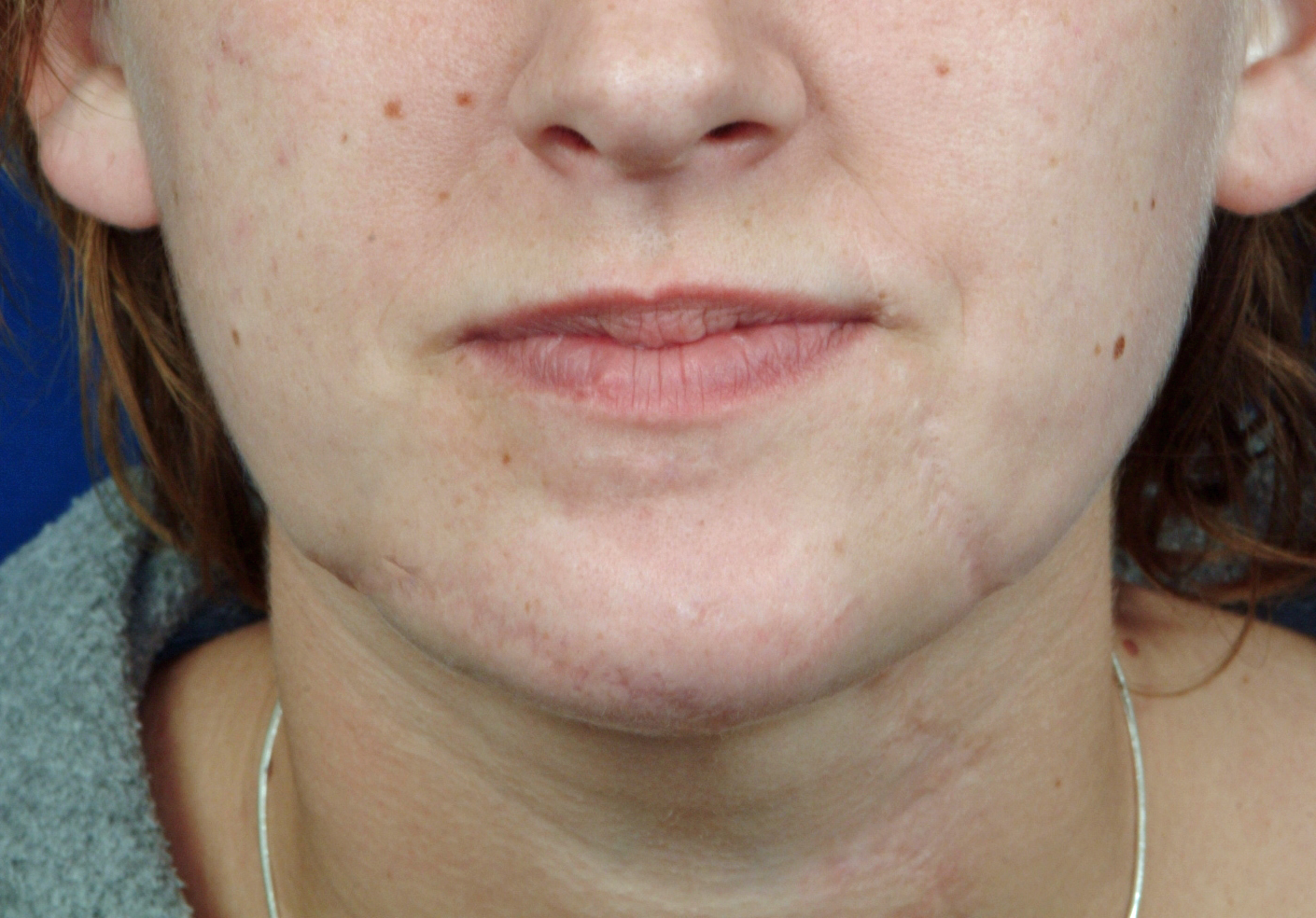 Facial Scar Revisions Before Dr Barry Eppley Plastic Surgery Explore