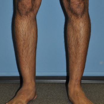 Common Questions about Body Implant Surgery - Explore Plastic Surgery