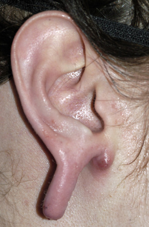 Ear Piercing  Barry Pediatrics