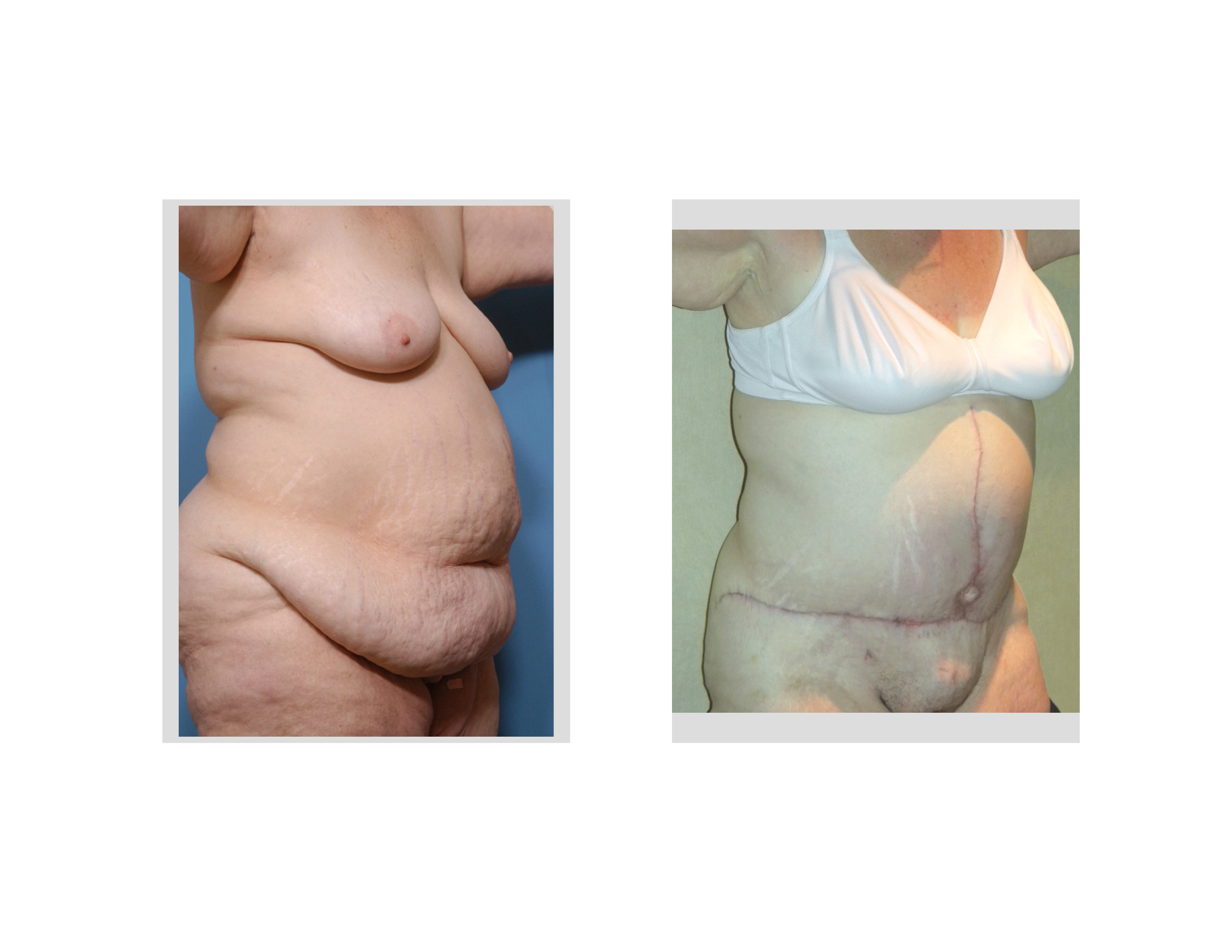 The Fleur-de-lis Abdominoplasty after Massive Weight Loss - Explore Plastic  Surgery