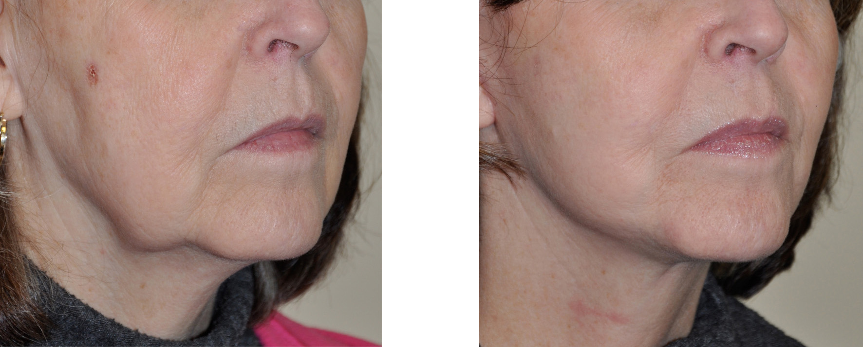 The Jawline Lift A 3/4 Facelift Explore Plastic Surgery